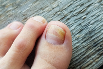 Reasons Your Toenails May Hurt