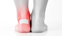 What to Do if Your Foot Blister Pops