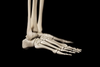 Understanding Stress Fractures in Athletes