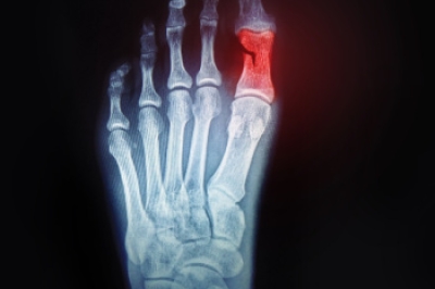 When to See a Podiatrist for a Broken Toe