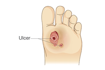 Causes and Treatment of Diabetic Foot Ulcers