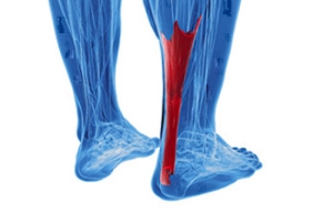 Causes of Achilles Tendonitis