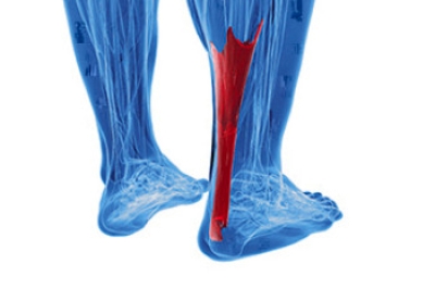 Causes of Achilles Tendonitis
