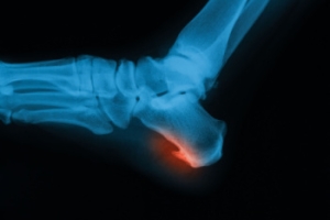 Heel Spurs and Their Classifications