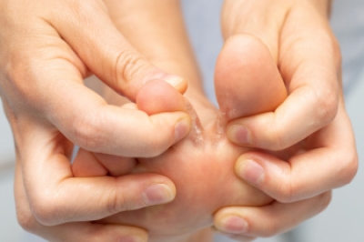Causes and Symptoms of Athlete’s Foot Explained