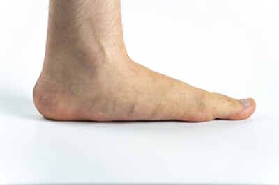 Understanding Flat Feet