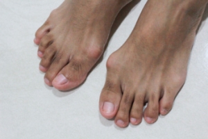 Surgical Remedies for Bunions
