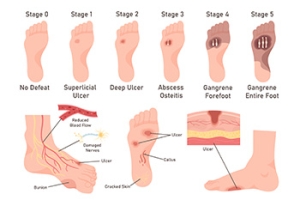Early Care of Foot Ulcers Is Vital