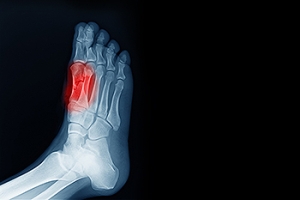 The Foot Pain Most People Have Not Heard Of