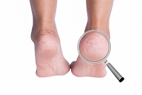 When Cracked Heels Need Professional Treatment
