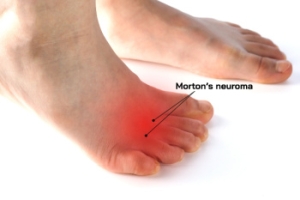Morton's Neuroma and Surgical Relief