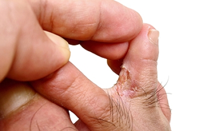 Athlete’s Foot Symptoms and Causes